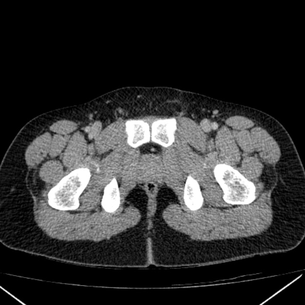 Acute appendicitis (Radiopaedia 38255-40270 Axial C+ portal venous phase 115).jpg