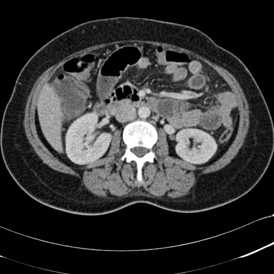 File:Acute appendicitis (Radiopaedia 48792-53822 Axial C+ portal venous phase 50).jpg