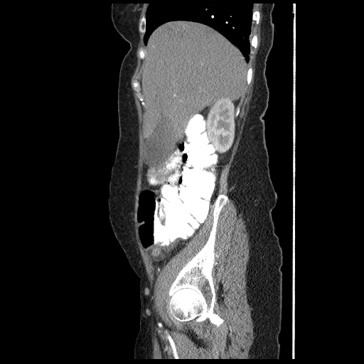 File:Acute appendicitis (Radiopaedia 52672-58589 Sagittal C+ arterial phase 24).jpg