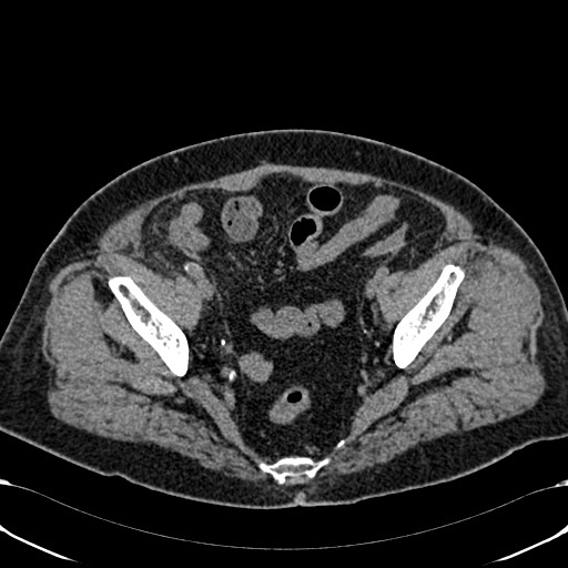 Acute appendicitis (Radiopaedia 58627-65818 Axial non-contrast 74).jpg