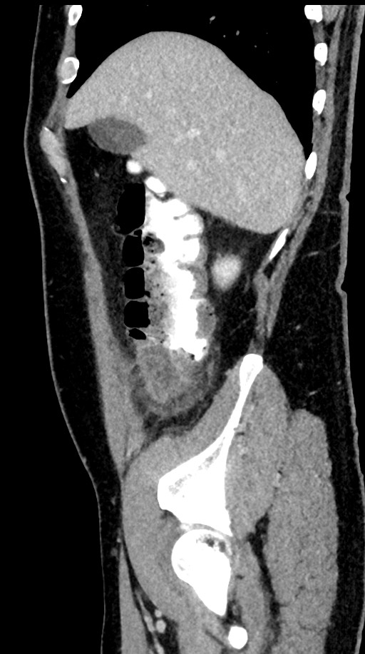 Acute appendicitis (Radiopaedia 77016-88960 Sagittal C+ portal venous phase 91).jpg