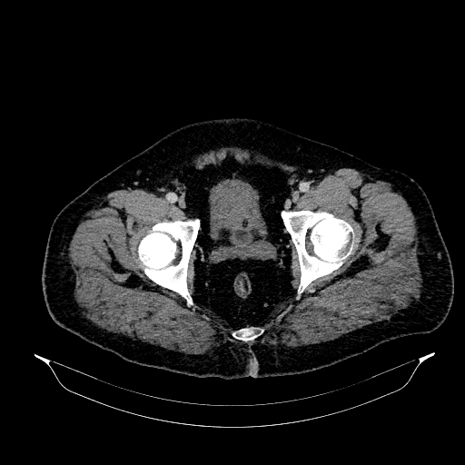Acute appendicitis (Radiopaedia 79950-93224 Axial C+ portal venous phase 95).jpg