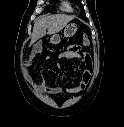 File:Acute appendicitis (Radiopaedia 79950-93224 Coronal C+ portal venous phase 18).jpg