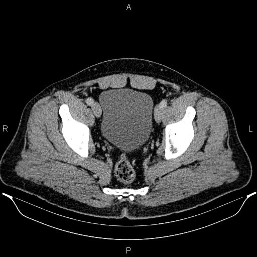 File:Acute appendicitis (Radiopaedia 84780-100240 Axial C+ portal venous phase 97).jpg