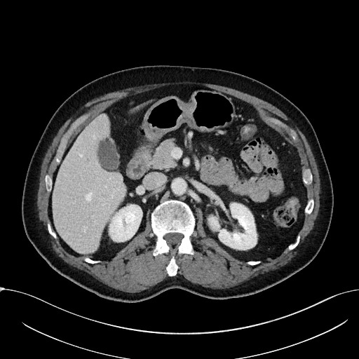 Acute appendicitis - large appendicoliths (Radiopaedia 61805-69820 Axial C+ portal venous phase 44).jpg