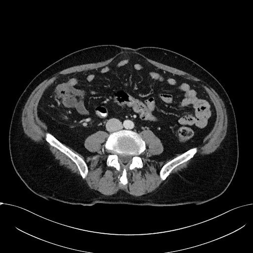 File:Acute appendicitis - large appendicoliths (Radiopaedia 61805-69820 Axial C+ portal venous phase 77).jpg