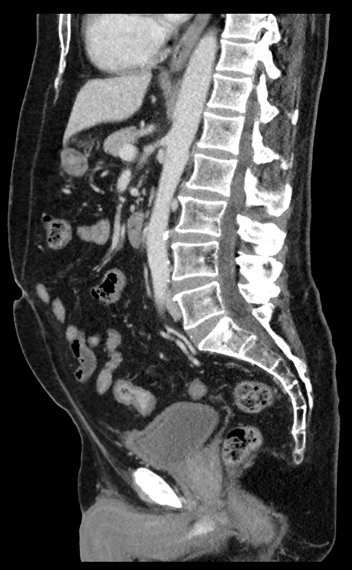 Acute appendicitis - large appendicoliths (Radiopaedia 61805-69820 Sagittal C+ portal venous phase 56).jpg