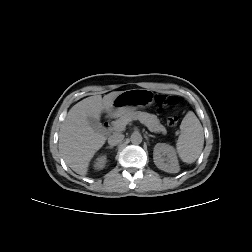 Acute appendicitis and COVID 19 pneumonia (Radiopaedia 76604-88380 Axial non-contrast 61).jpg