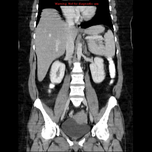 Acute appendicitis complicated by ovarian vein thrombophlebitis (Radiopaedia 16172-15851 Coronal C+ portal venous phase 46).jpg