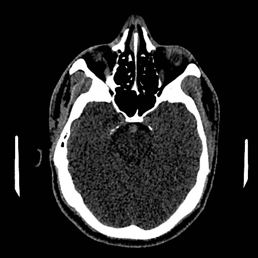 File:Acute basilar artery occlusion (Radiopaedia 43582-46985 Axial non-contrast 69).jpg
