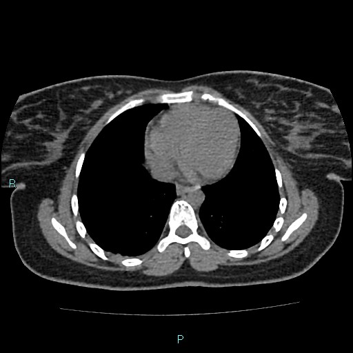 File:Acute bilateral pyelonephritis (Radiopaedia 37146-38881 Axial non-contrast 1).jpg