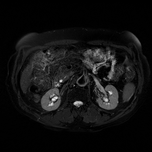 File:Acute cholecystitis complicated by pylephlebitis (Radiopaedia 65782-74915 Axial T2 fat sat 28).jpg