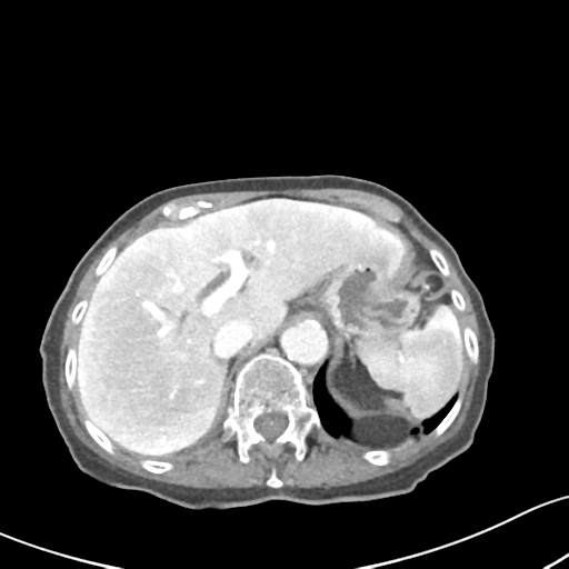 Acute cholecystitis with contained perforation (Radiopaedia 47328-51907 Axial C+ portal venous phase 17).png