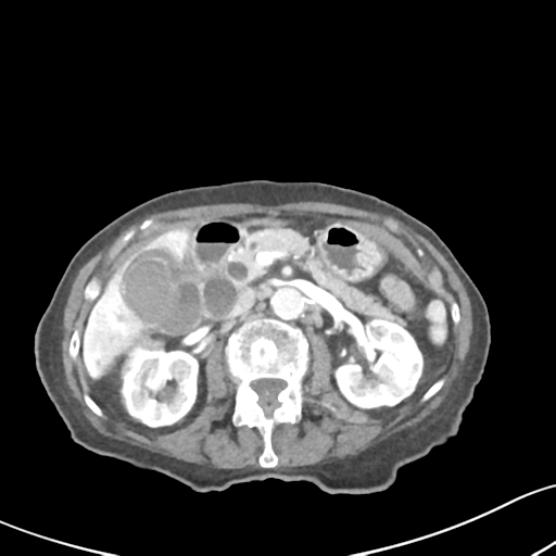 File:Acute cholecystitis with contained perforation (Radiopaedia 47328-51907 Axial C+ portal venous phase 28).png