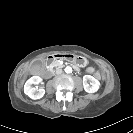 Acute cholecystitis with contained perforation (Radiopaedia 47328-51907 Axial C+ portal venous phase 34).png
