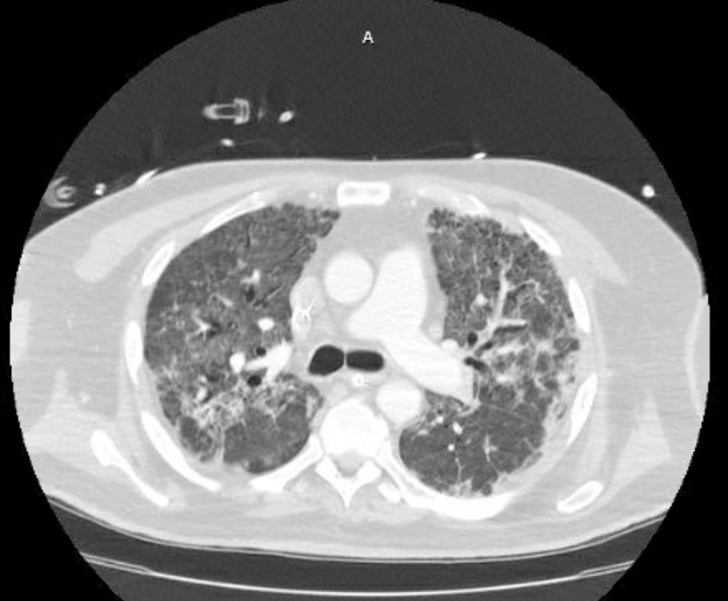 Acute cor pulmonale (ultrasound) (Radiopaedia 83508-98818 Axial lung window 36).jpg