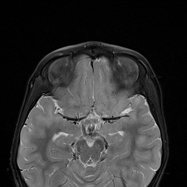 File:Acute disseminating encephalomyelitis with bilateral optic neuritis (Radiopaedia 79676-92886 Axial STIR 11).jpg