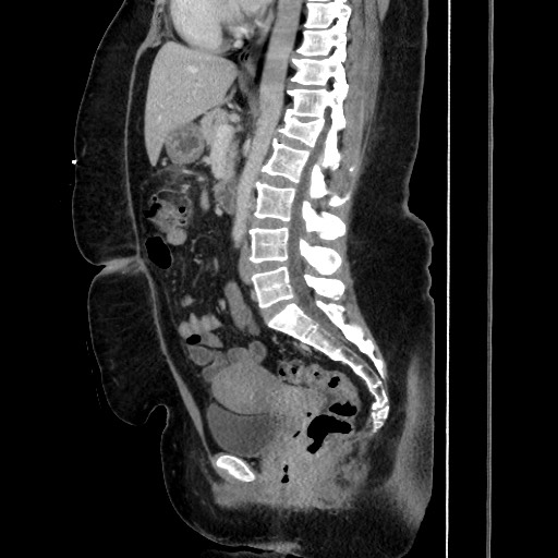 Acute diverticulitis - transverse colon (Radiopaedia 87063-103327 Sagittal C+ portal venous phase 123).jpg
