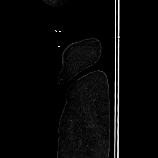 Acute diverticulitis - transverse colon (Radiopaedia 87063-103327 Sagittal C+ portal venous phase 222).jpg