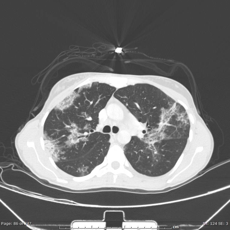 Acute eosinophilic pneumonia (Radiopaedia 48211-53073 Axial lung window 31).jpg