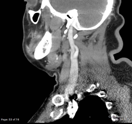 Acute epiglottitis (Radiopaedia 54375-60590 Sagittal C+ arterial phase 53).jpg