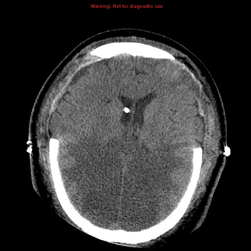Acute hemorrhagic leukoencephalitis (Radiopaedia 14076-43697 Axial non-contrast 30).jpg