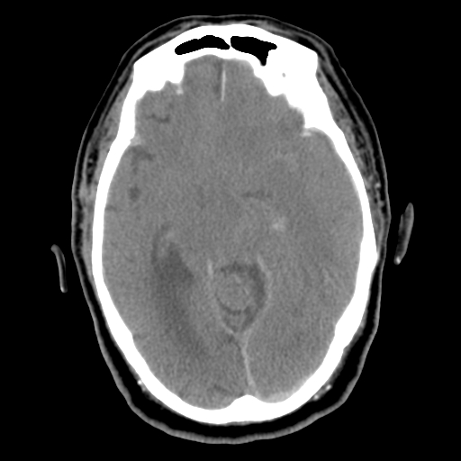 Acute hemorrhagic stroke (Radiopaedia 17507-17223 Axial non-contrast 22).jpg