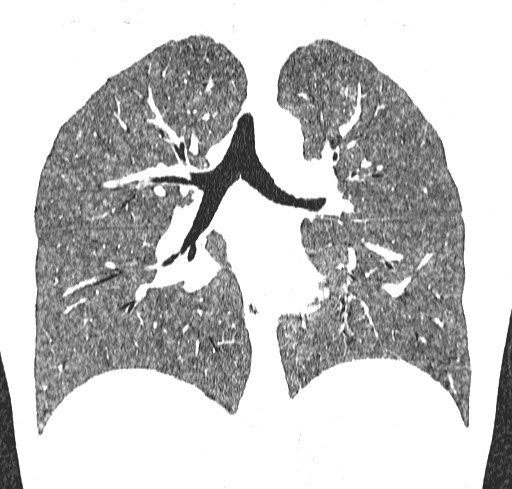 Acute hypersensitivity pneumonitis (Radiopaedia 85293-100870 Coronal lung window 74).jpg