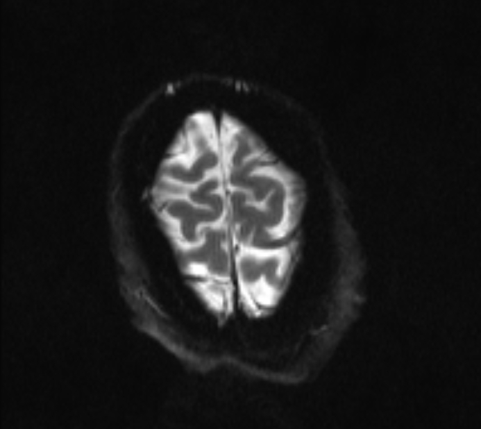 Acute ischemic stroke - posterior circulation territory (Radiopaedia 77670-89880 Axial DWI 22).jpg