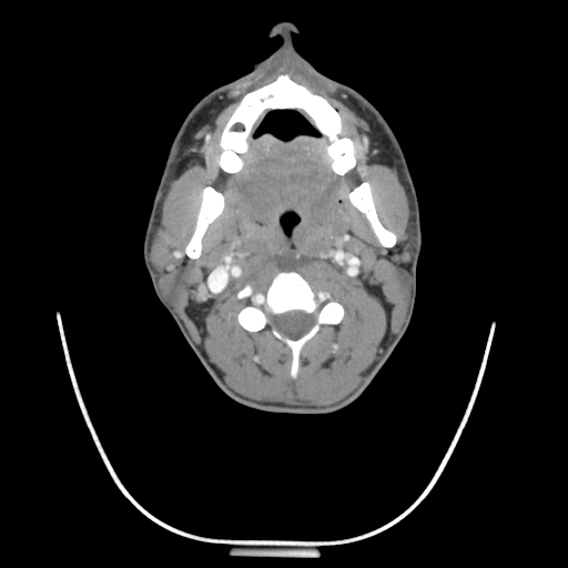 Acute longus colli calcific tendinitis (Radiopaedia 72495-83036 Axial C+ arterial phase 33).jpg