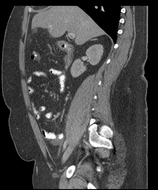 Acute mesenteric venous ischemia (Radiopaedia 46041-50383 Sagittal C+ portal venous phase 43).jpg