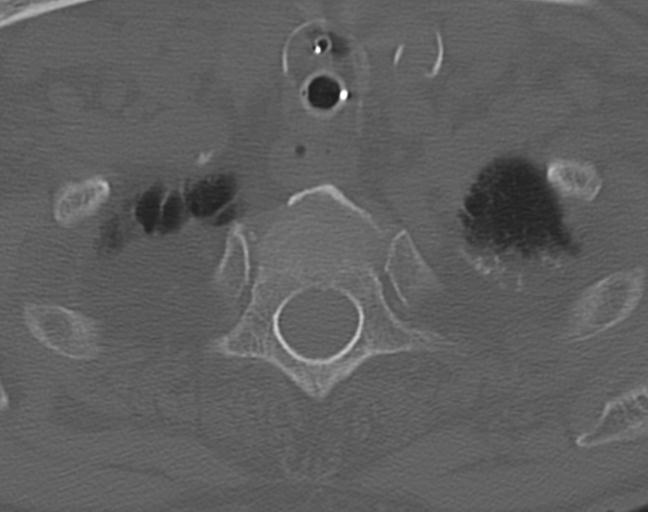 Acute on chronic subdural hematoma and thoracic vertebral injury in a multitrauma patient (Radiopaedia 31698-32619 Axial bone window 57).jpg