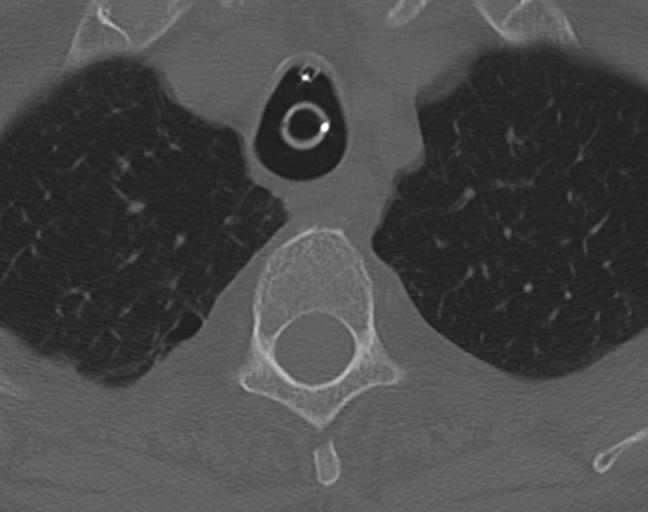 Acute on chronic subdural hematoma and thoracic vertebral injury in a multitrauma patient (Radiopaedia 31698-32619 Axial bone window 66).jpg