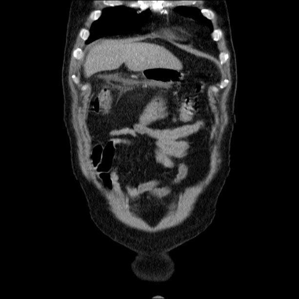 Acute pancreatitis (Radiopaedia 26663-26813 Coronal C+ portal venous phase 13).jpg