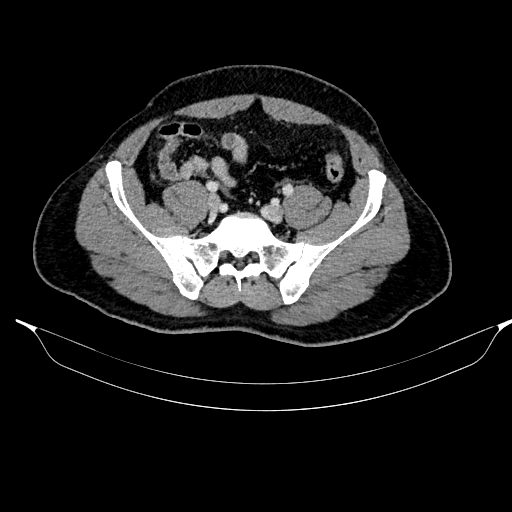 Acute pancreatitis (Radiopaedia 87428-103757 Axial C+ portal venous phase 75).jpg