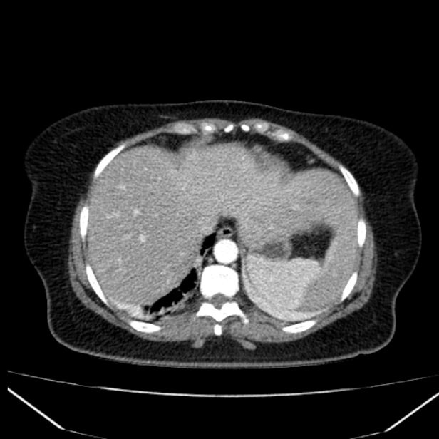 Acute pancreatitis - Balthazar C (Radiopaedia 26569-26714 Axial C+ arterial phase 12).jpg