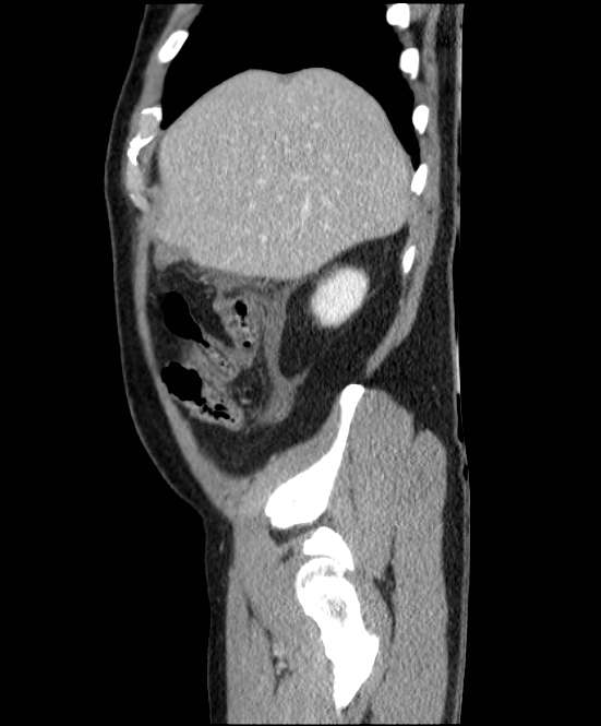 Acute pancreatitis - Balthazar E (Radiopaedia 23080-23110 Sagittal C+ portal venous phase 14).jpg