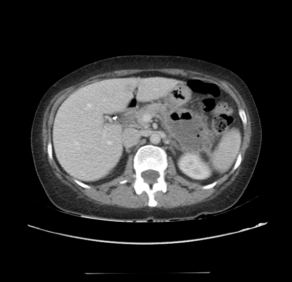 File:Acute pancreatitis - Balthazar E - post ERCP (Radiopaedia 27562-27772 Axial C+ portal venous phase 26).png