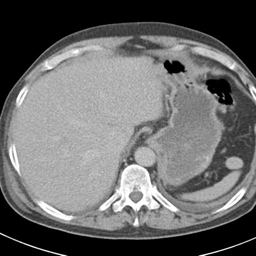 File:Acute pancreatitis and walled-off necrosis (Radiopaedia 29888-30403 Axial C+ delayed 17).jpg