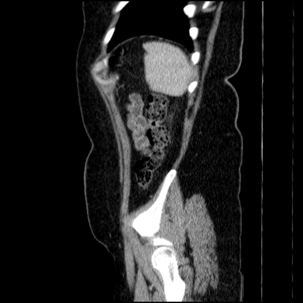 Acute pyelonephritis (Radiopaedia 33397-34434 Sagittal renal parenchymal phase 75).jpg