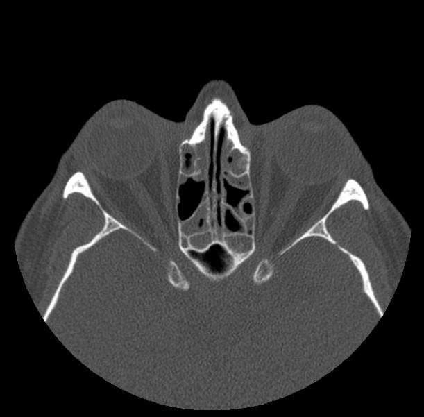Acute sinusitis (Radiopaedia 23161-23215 Axial bone window 48).jpg