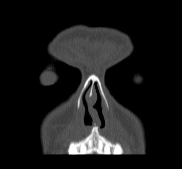Acute sinusitis (Radiopaedia 23161-23215 Coronal bone window 18).jpg