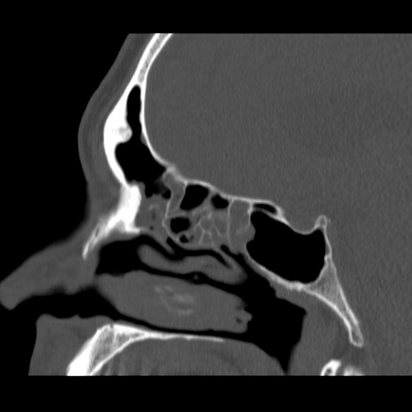 Acute sinusitis (Radiopaedia 23161-23215 Sagittal bone window 36).jpg