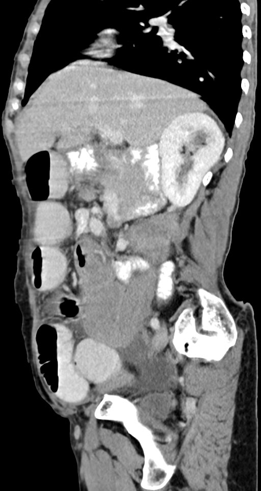 Acute small bowel (ileal) volvulus (Radiopaedia 71740-82139 Sagittal C+ portal venous phase 109).jpg