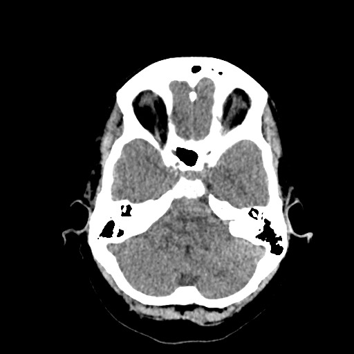 Acute subarachnoid hemorrhage and accessory anterior cerebral artery (Radiopaedia 69231-79008 Axial non-contrast 13).jpg