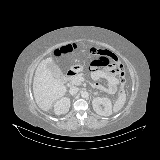 Acute superior mesenteric artery occlusion (Radiopaedia 51288-56960 Axial lung window 14).jpg