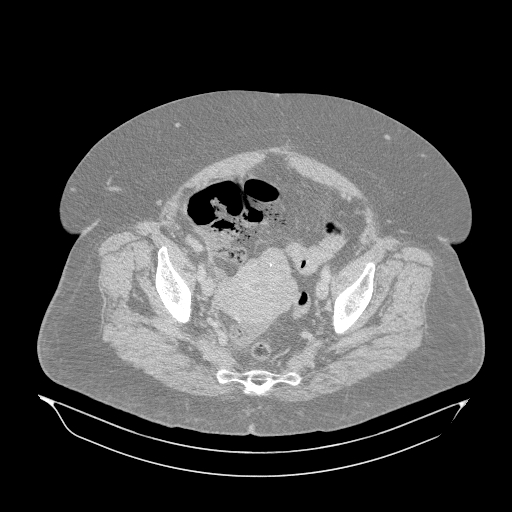 File:Acute superior mesenteric artery occlusion (Radiopaedia 51288-56960 Axial lung window 65).jpg