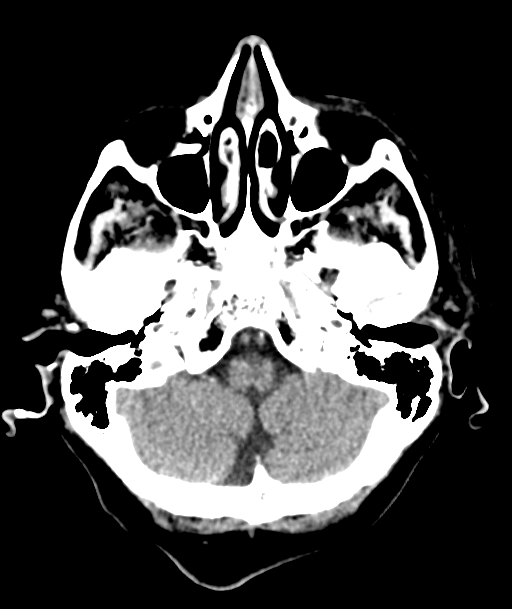 Acute traumatic subdural hematoma (Radiopaedia 82921-97257 Axial non-contrast 53).jpg