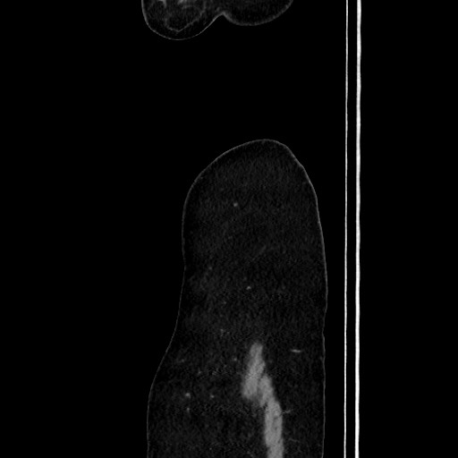 Acute uncomplicated appendicitis (Radiopaedia 73704-84499 Sagittal C+ portal venous phase 29).jpg