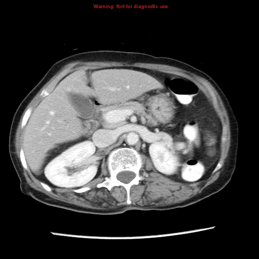 File:Adenocarcinoma of the colon (Radiopaedia 8191-9039 Axial liver window 26).jpg